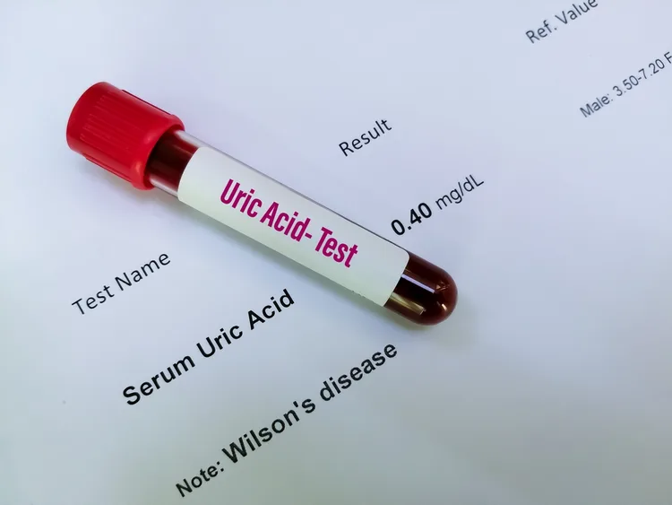 Imagine cu analiza sange pentru test acid uric