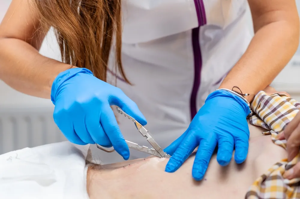 asistenta medicala care scoate firele de sutura de pe pielea unui pacient