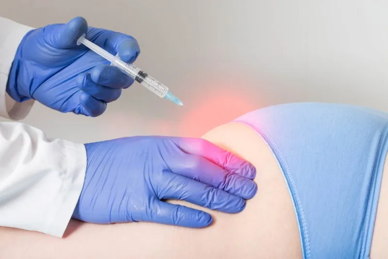 reprezentare grafica a afectarii nervului din cauza unei injectii
