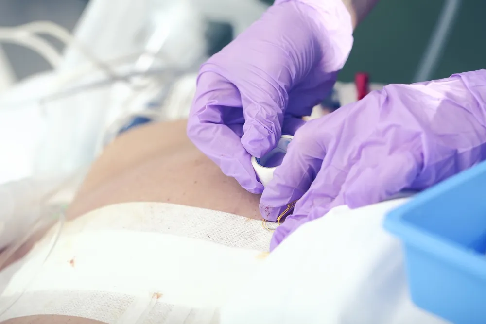 Ingrijirea plagii postoperatorii