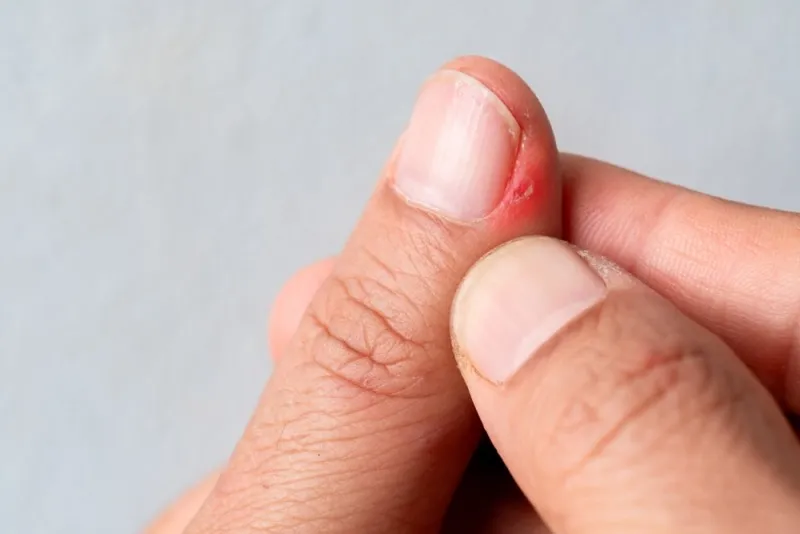 imagine cu un deget care coace din cauza unei infectii