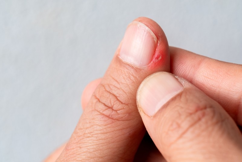 imagine cu un deget care coace din cauza unei infectii